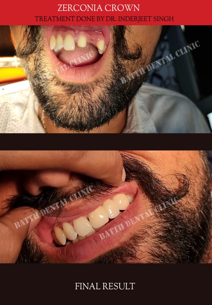 Before and after zirconia crown treatment